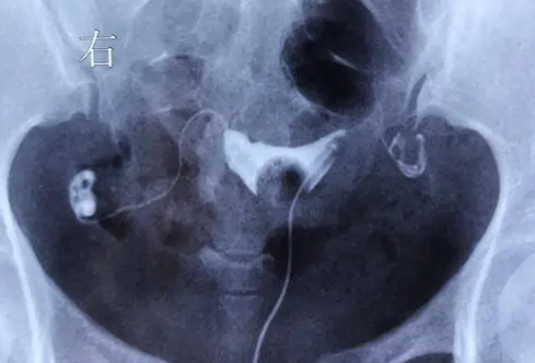 輸卵管檢查能幫助女性知道自己生育能力，做一次檢查的費(fèi)用看完就知