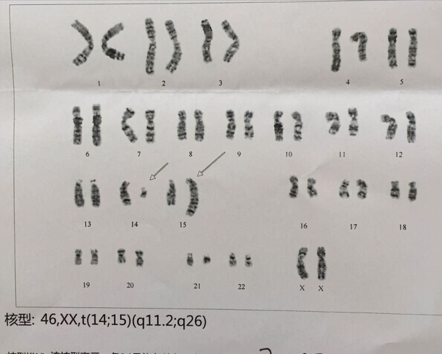 染色體+精子質(zhì)量三大檢查，男性孕前必查利器