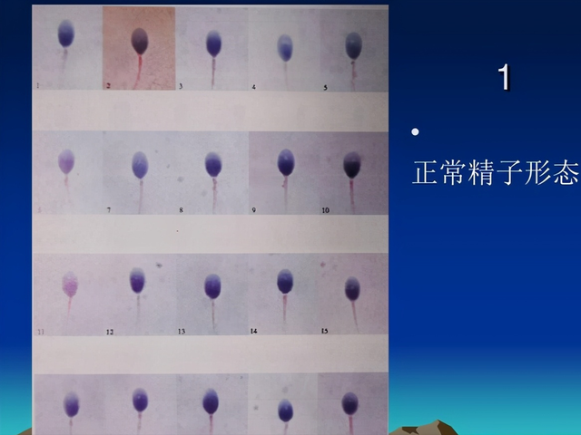 染色體+精子質(zhì)量三大檢查，男性孕前必查利器