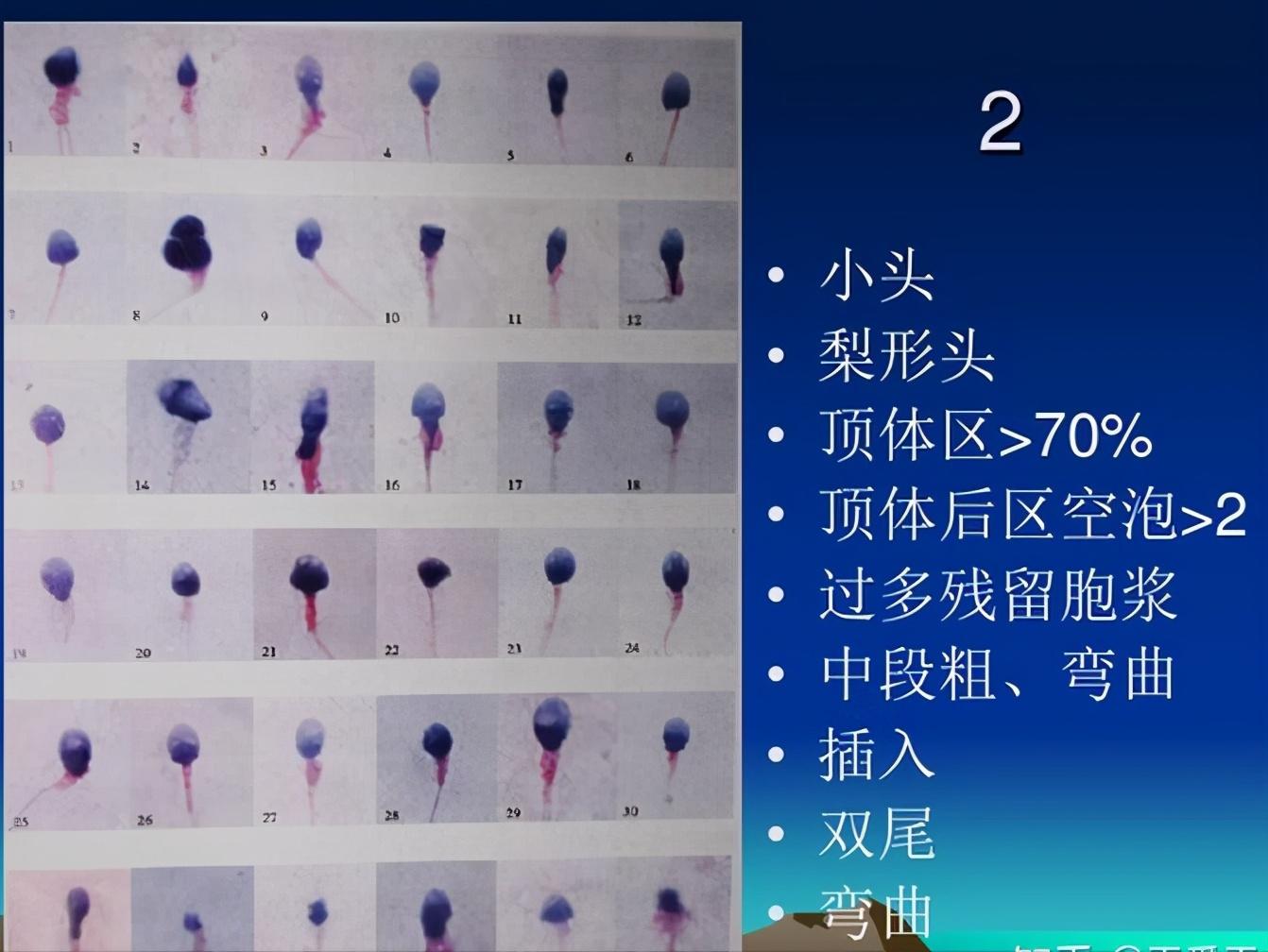 染色體+精子質(zhì)量三大檢查，男性孕前必查利器