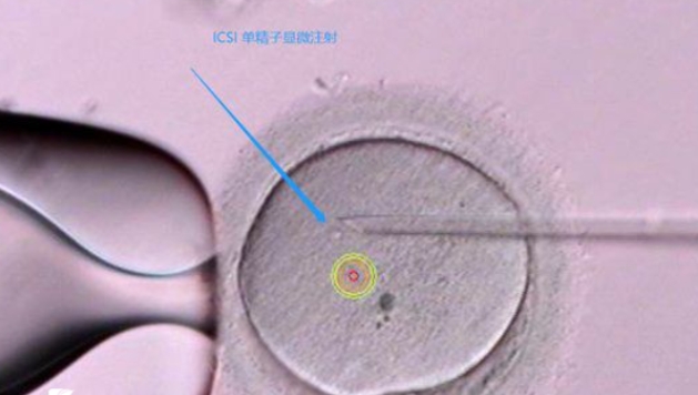 2024做試管嬰兒移植費(fèi)用大概要多少錢(qián)？