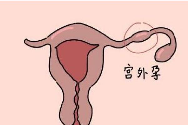 宮外孕試紙能測(cè)出來嗎 宮外孕hcg值的范圍