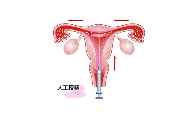 做人工授精應該去幾次醫(yī)院？