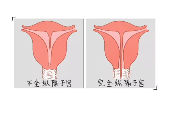 女性有不完全縱隔子宮可以順利生產(chǎn)嗎？