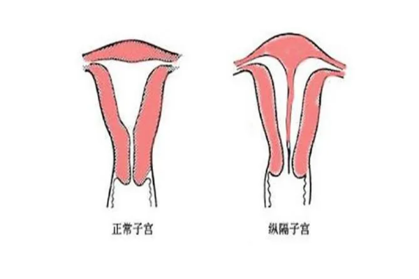 不完全縱隔子宮要做手術(shù)嗎？哪些情況要做手術(shù)？