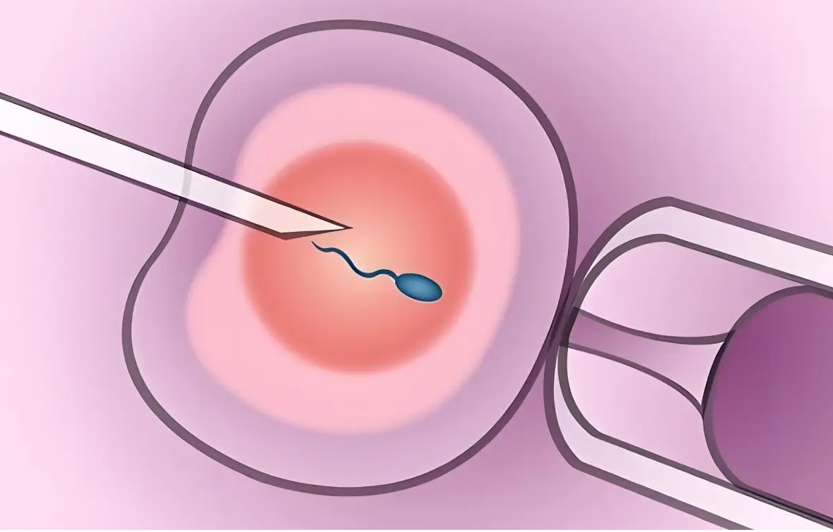 切除一側(cè)輸卵管后做造影檢查會很疼嗎？