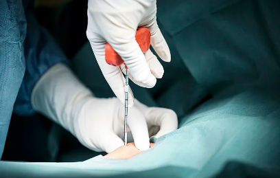 干細胞有填充功效嗎？適用于哪些情況？