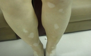 武漢看白癜風(fēng)醫(yī)院哪家好如何快速恢復(fù)腿部的白斑呢