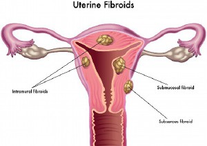 廣州試管嬰兒費用多少？如何優(yōu)化？