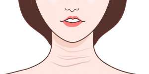 去頸紋比較好的方法是什么？去做什么項(xiàng)目會(huì)比較好？