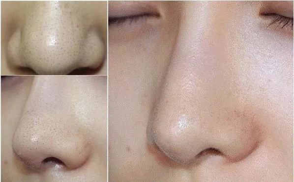 淄博市收縮鼻子毛孔醫(yī)院這些醫(yī)院受到一致好評(píng)！