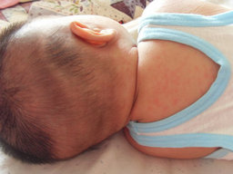 什么是小兒痱毒