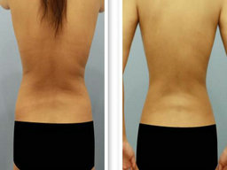 奧利司他膠囊減肥藥多久見效